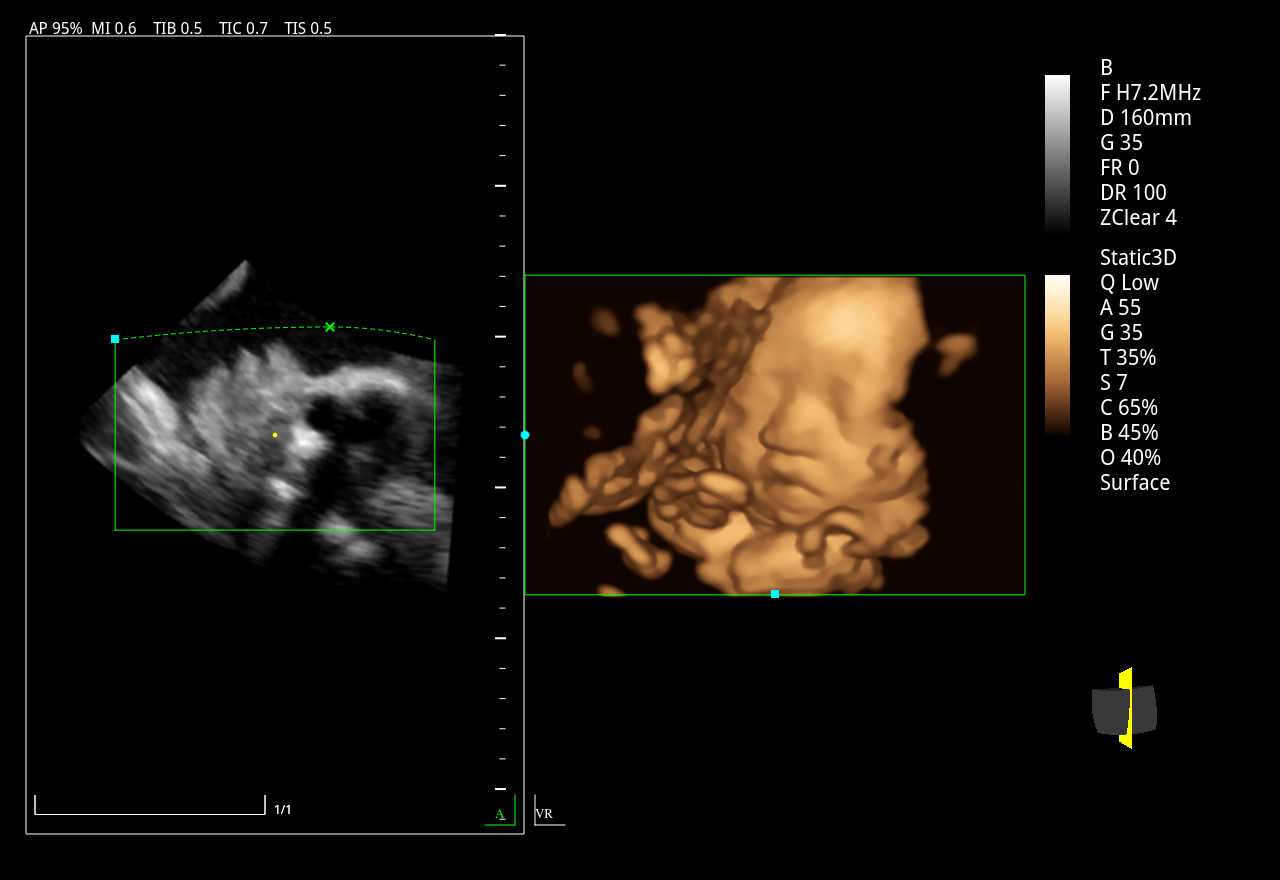 Zoncare M30 with 4D Probe + 4D Software